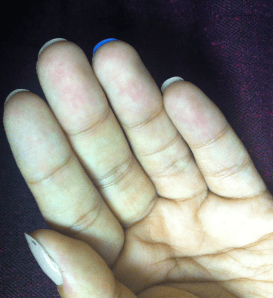 Today in age!- This may not seem long for some, but I assure you my nails never grew past the skin my entire life! I am ecstatic with their progress and those who know me can tell the difference immediately.